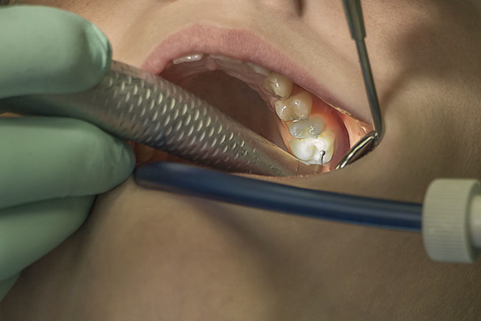 Dentista realizando revisión dental a un paciente